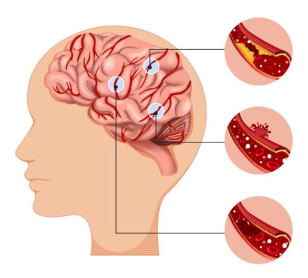 Các xét nghiệm đột quỵ trong phòng thí nghiệm