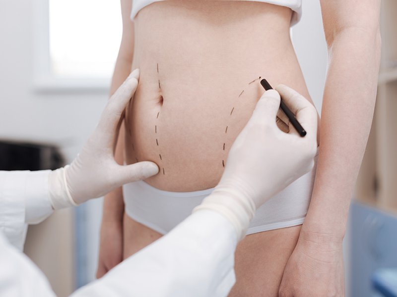 phẫu thuật giảm cân