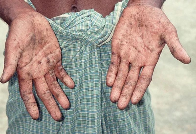 dấu hiệu cơ thể nhiễm chì