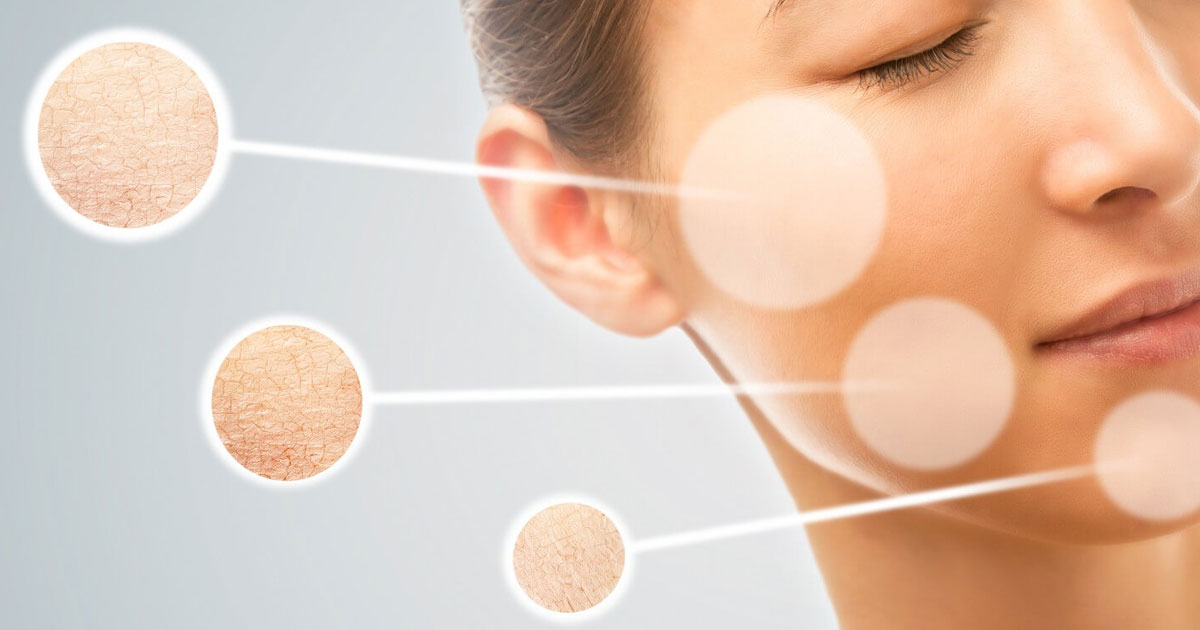 Da bị mất nước