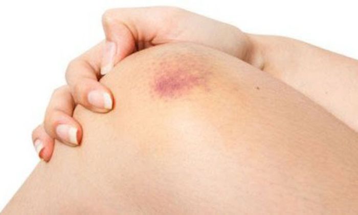 cách điều trị vỡ tĩnh mạch