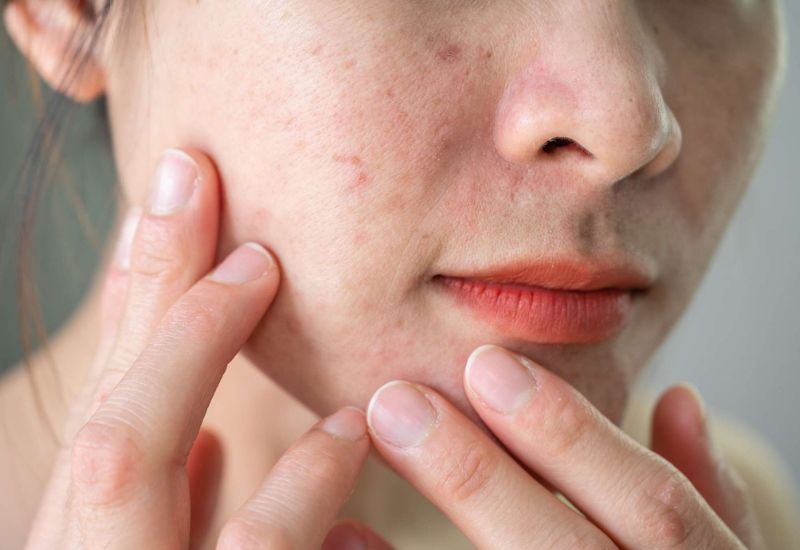 cách trị da sần sùi