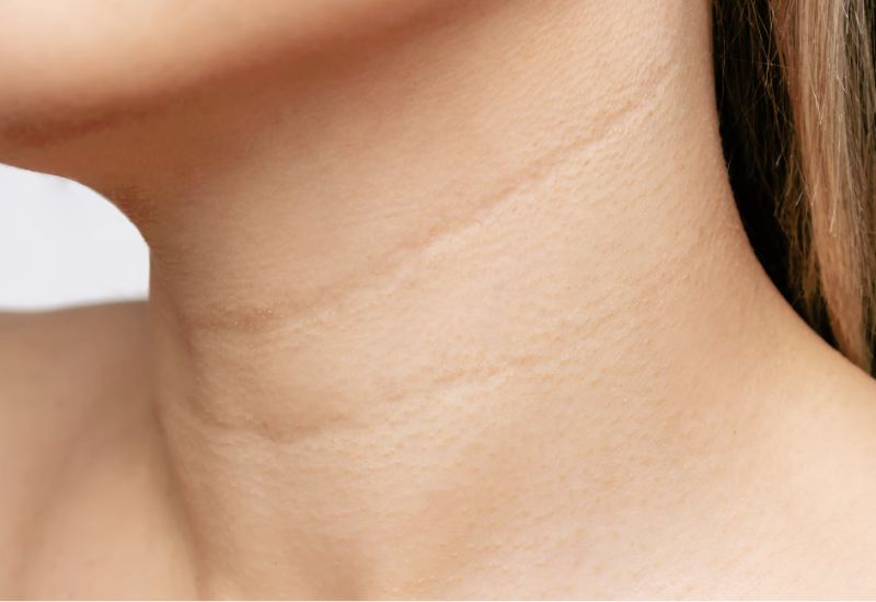 da cổ bị chùng nhão