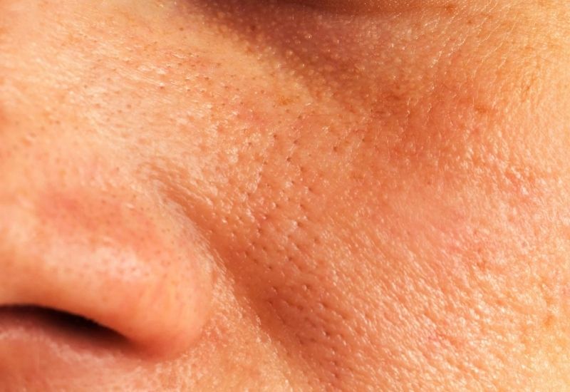 da sần sùi lỗ chân lông to