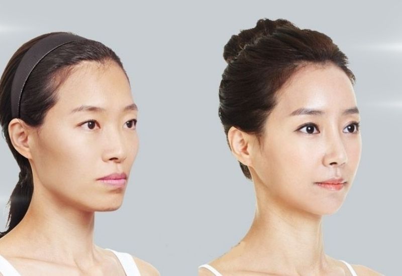 hõm thái dương là gì