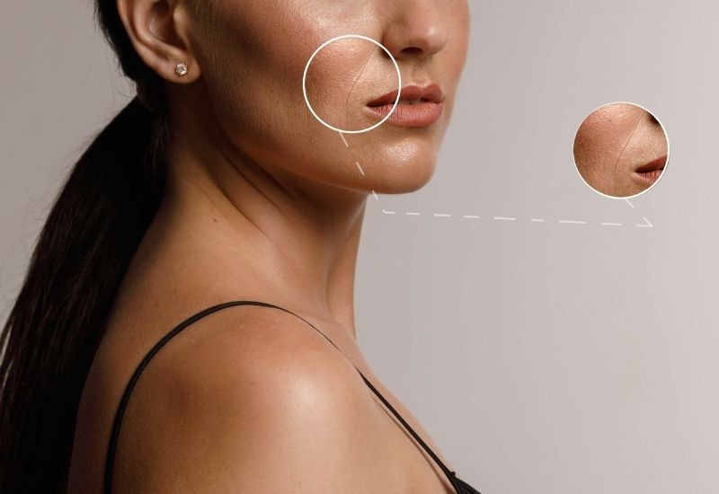 nếp nhăn rãnh cười