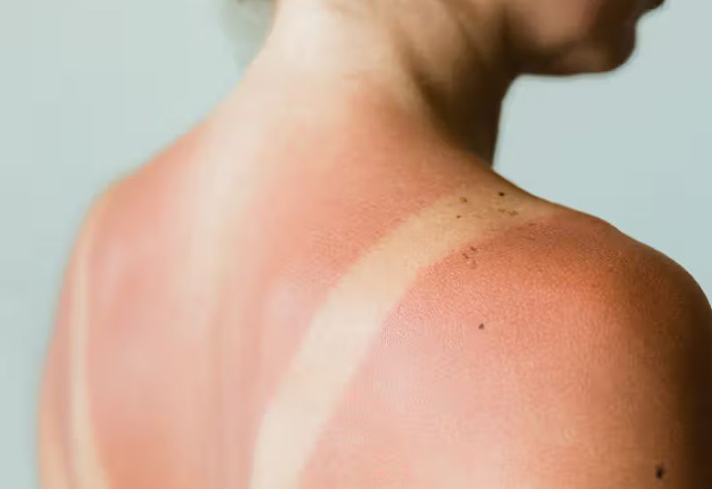 nhiễm độc xi măng