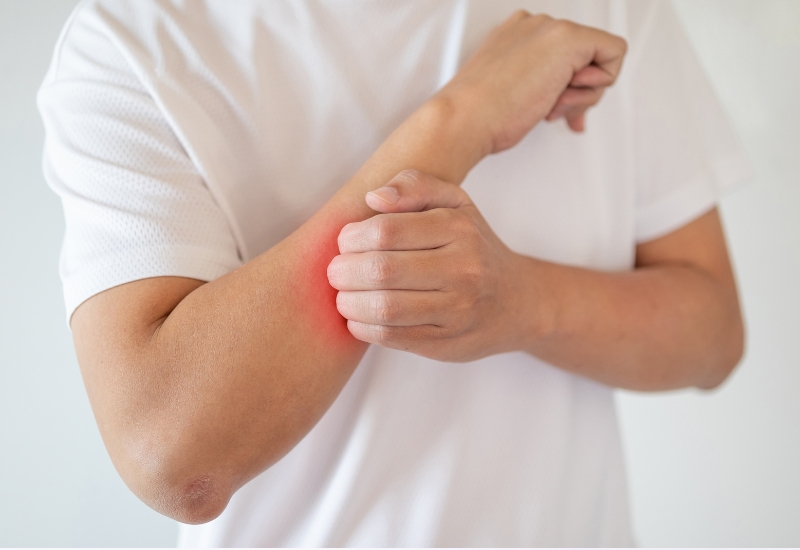 cách chữa viêm da thần kinh