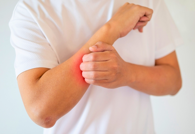 dấu hiệu vảy nến