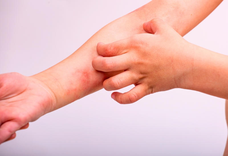điều trị viêm da dị ứng