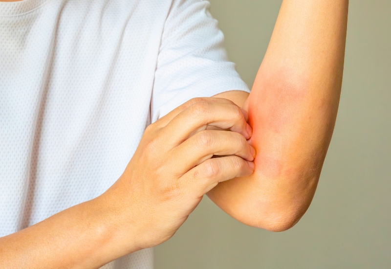 nguyên nhân gây bệnh chàm da