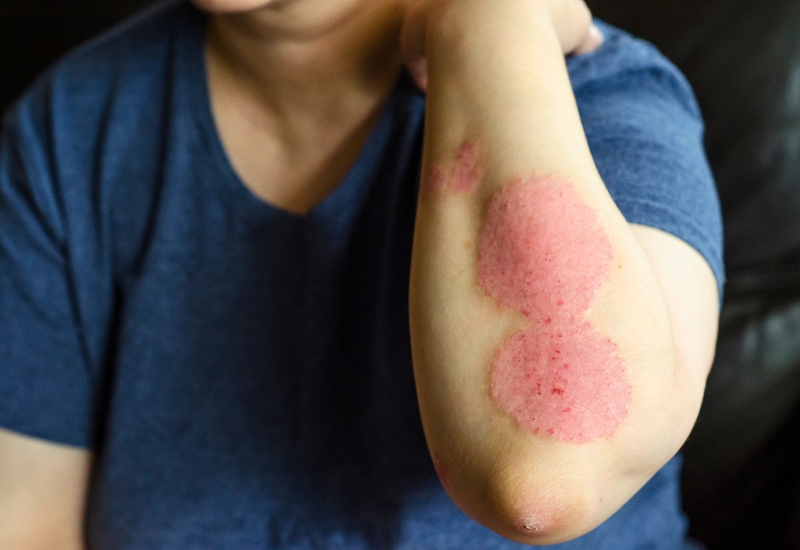 những dấu hiệu của bệnh chàm da