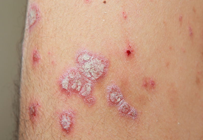 tại sao bị vảy nến