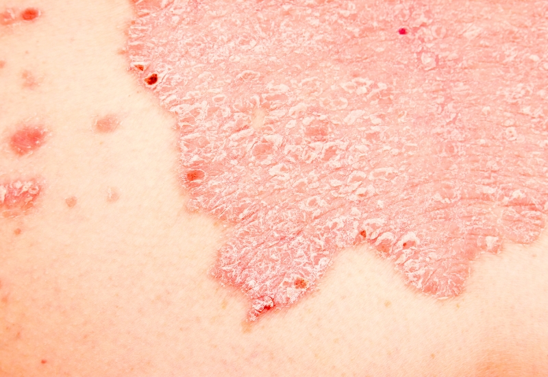 vảy nến biến chứng