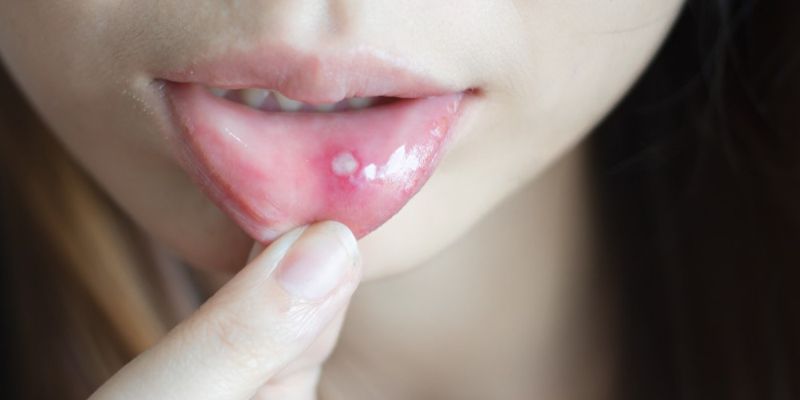 nguy-co-thieu-vitamin-c-gay-nhiet-mieng-va-cach-bo-sung
