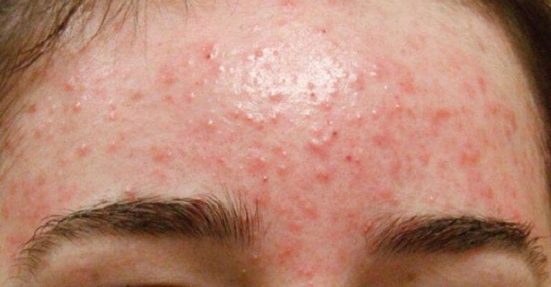 Bệnh gan da sạm đen còn có thể đi kèm các dấu hiệu như nổi mụn nhiều