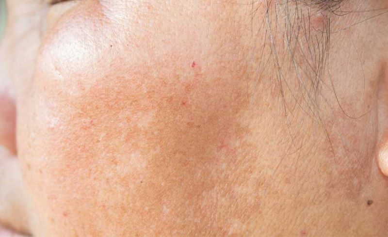 Da sạm đen do gan thường xuất phát từ việc chức năng gan bị suy giảm