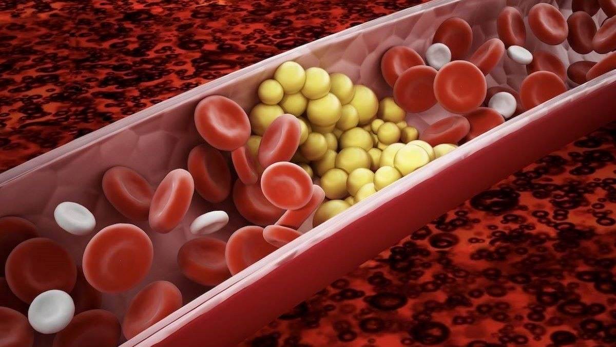 Dấu hiệu mỡ máu tăng cao