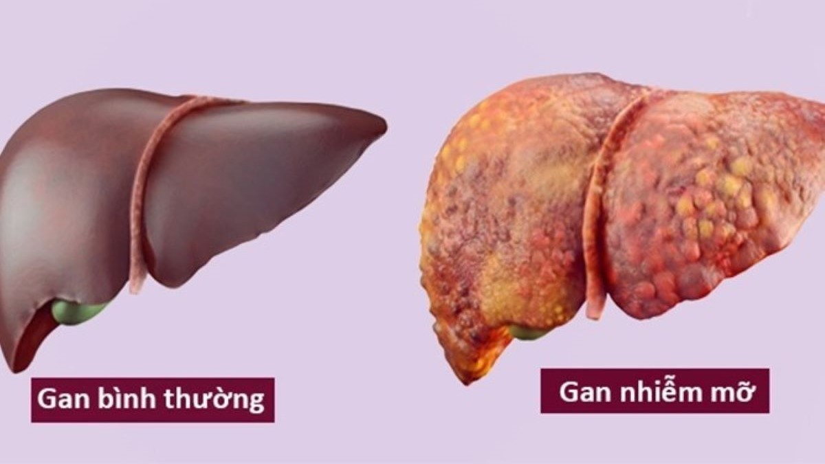 Gan nhiễm mỡ độ 1 là gì