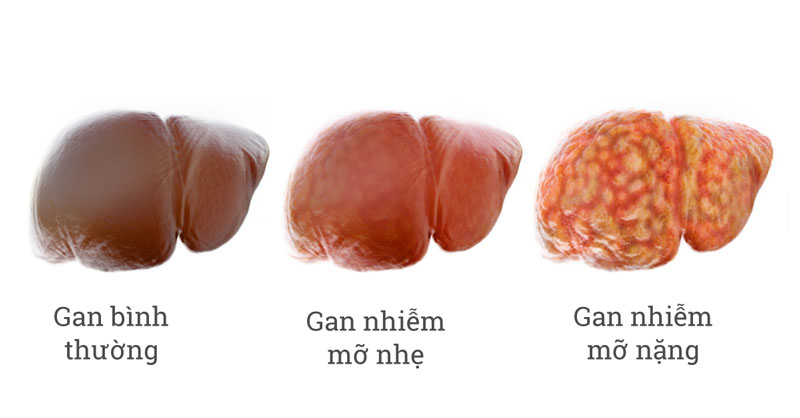 Gan nhiễm mỡ độ 1 là sao là thắc mắc được nhiều người quan tâm