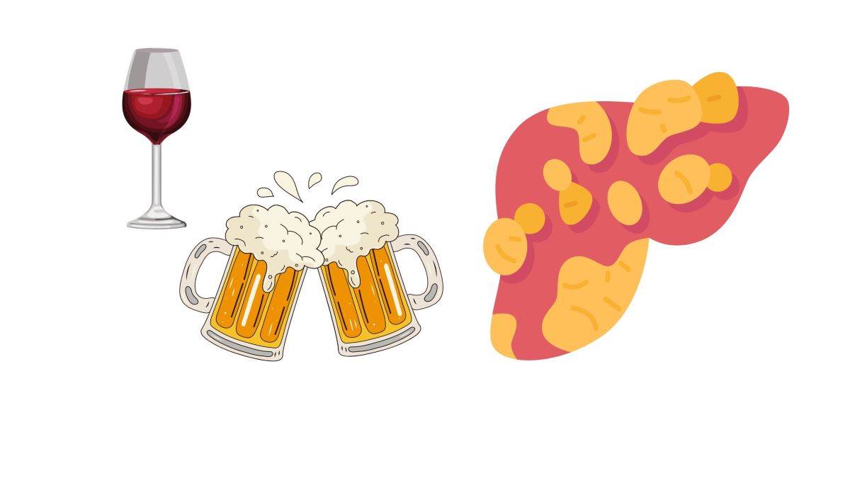 Cảnh báo gan nhiễm mỡ do rượu