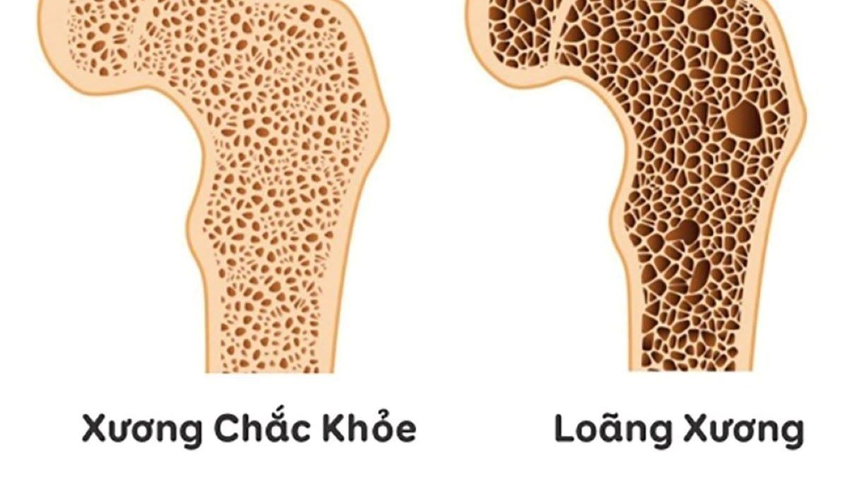 Kiểm tra loãng xương bằng cách nào