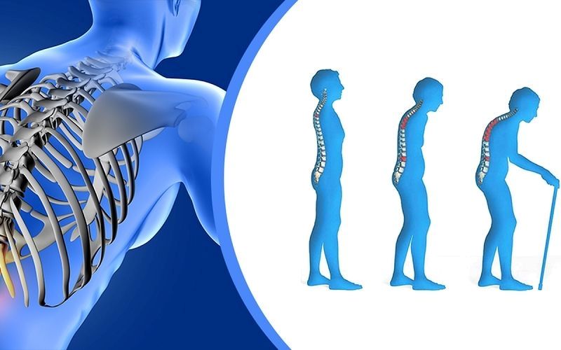 Việc đo mật độ xương sớm giúp phát hiện tình trạng mất xương