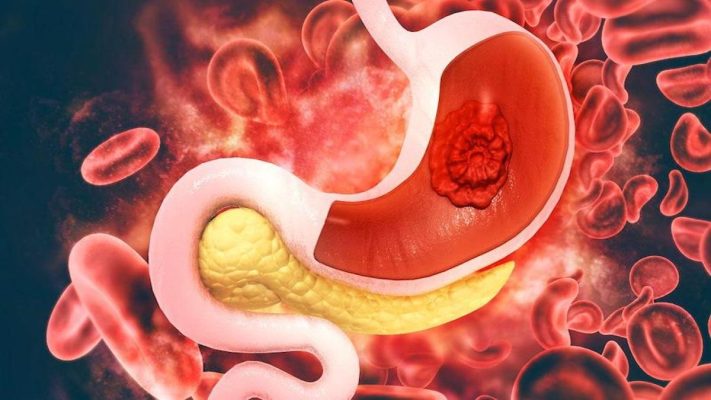 Xuất huyết đường tiêu hóa: Xử lý nhanh tránh biến chứng