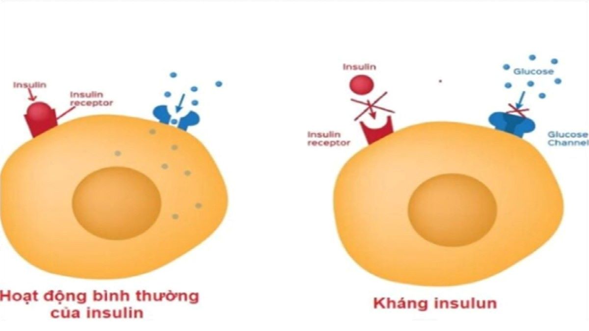 Kháng insulin là như thế nào