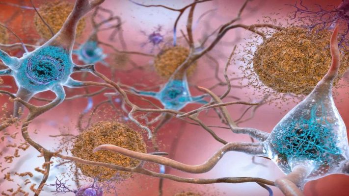 Beta-amyloid: Thủ phạm gây Alzheimer và cách ngăn chặn