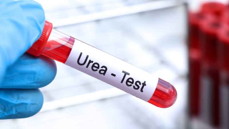 Chỉ số ure máu là gì là vấn đề được nhiều người quan tâm (Ảnh: Sưu tầm Internet)