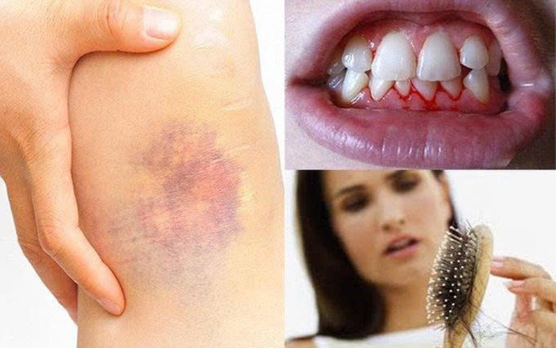 Những dấu hiệu thiếu vitamin C dễ nhận biết nhất (Ảnh: Sưu tầm Internet)