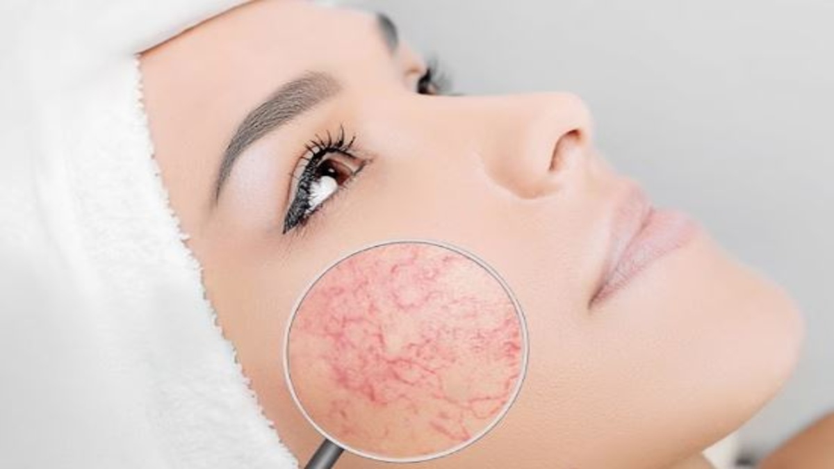 Giãn mao mạch da: Nguyên nhân & 4 cách điều trị hiệu quả nhất