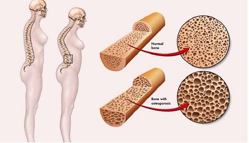 Hormone estradiol ảnh hưởng đến loãng xương sau mãn kinh (Ảnh: Sưu tầm Internet)
