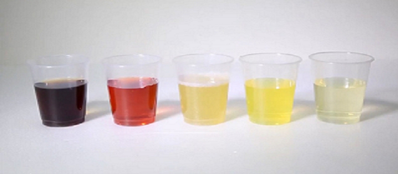 Protein trong nước tiểu cao thể hiện qua màu sắc nước tiểu (Ảnh: Sưu tầm Internet)