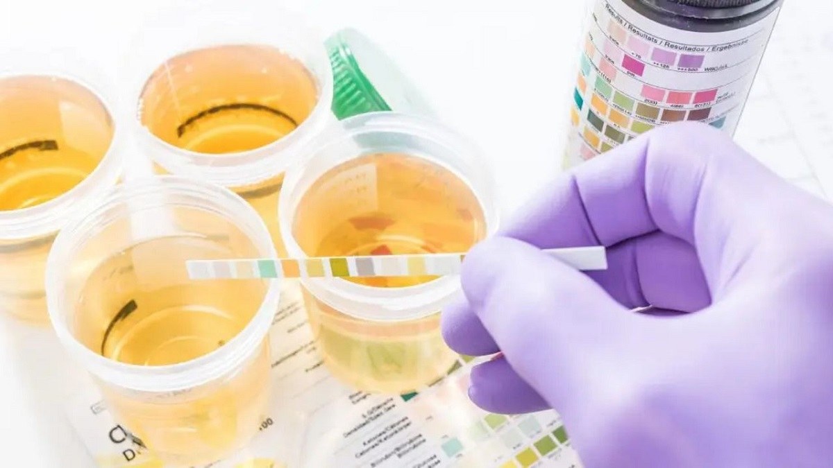 Dấu hiệu cảnh báo khi protein trong nước tiểu cao