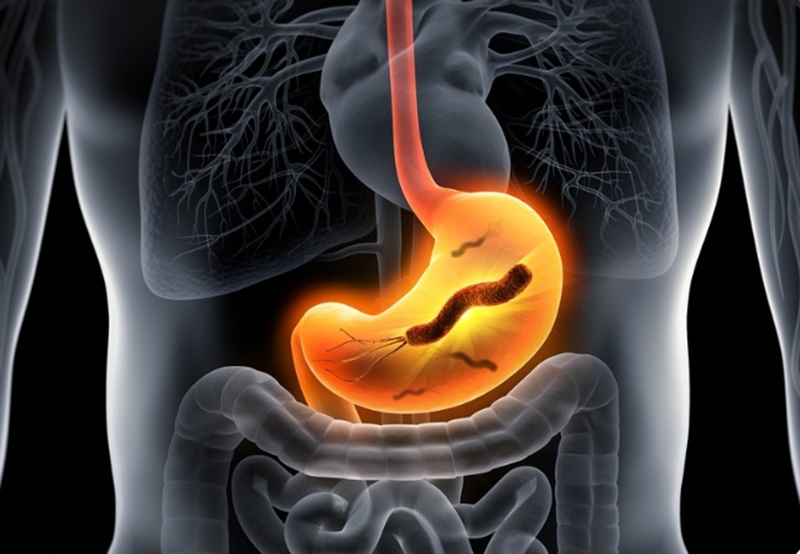 Bệnh viêm dạ dày do vi khuẩn Helicobacter pylori gây ra biến chứng nguy hiểm (Ảnh: Sưu tầm Internet)