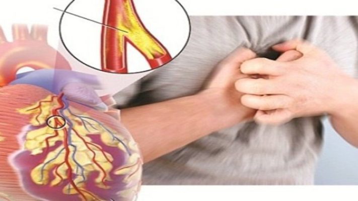 Xơ vữa động mạch