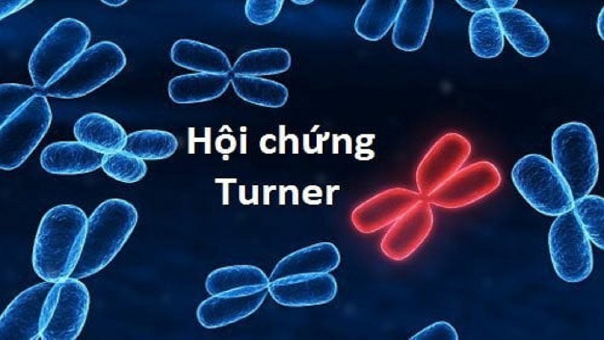 Hội chứng Turner XO là gì? Những điều cần biết về tình trạng di truyền hiếm gặp ở nữ