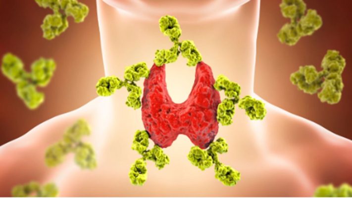 Bệnh viêm tuyến giáp tự miễn có nguy hiểm không?