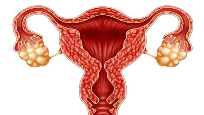 Bệnh buồng trứng đa nang có sao không? 5 dấu hiệu nhận biết sớm nhất