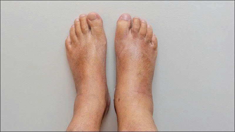 Phù nề chân tay là dấu hiệu phổ biến của việc máu lưu thông kém (Ảnh: Sưu tầm Internet)