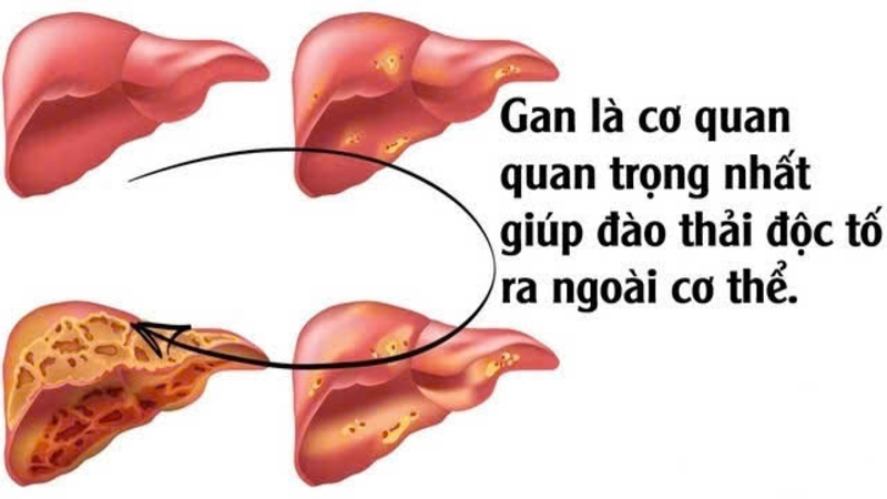 Gan đóng vai trò trung tâm trong hệ thống thải độc của cơ thể Gan đóng vai trò trung tâm trong hệ thống thải độc của cơ thể