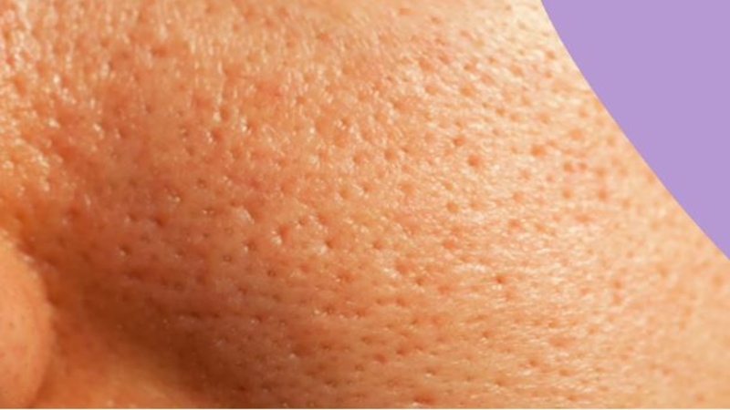 Tắc nghẽn lỗ chân lông là một trong những hiện tượng break out Tắc nghẽn lỗ chân lông là một trong những hiện tượng break out