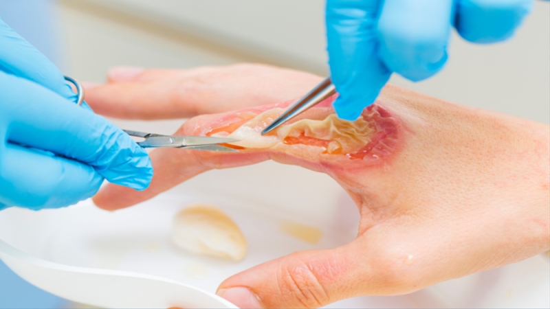 Các yếu tố làm chậm khả năng chữa lành vết thương (Ảnh: Sưu tầm Internet)