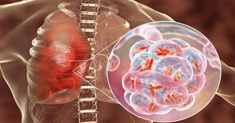 Vì sao nội độc tố vi khuẩn làm suy giảm miễn dịch?