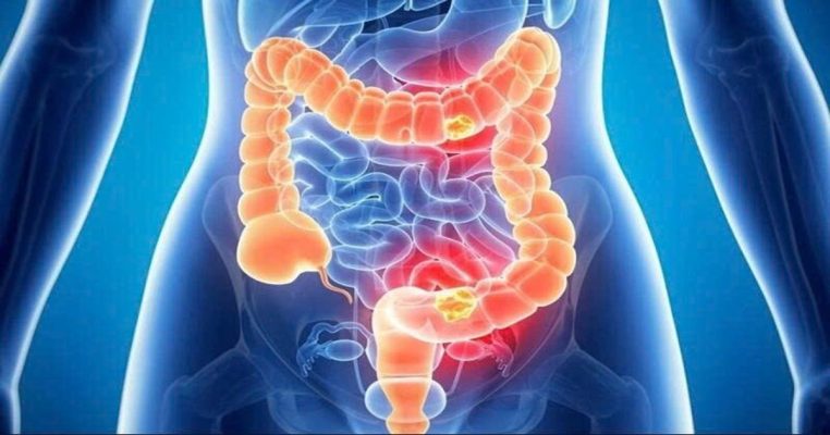 4 phương pháp thải độc đại tràng - Giải pháp thanh lọc cơ thể tự nhiên