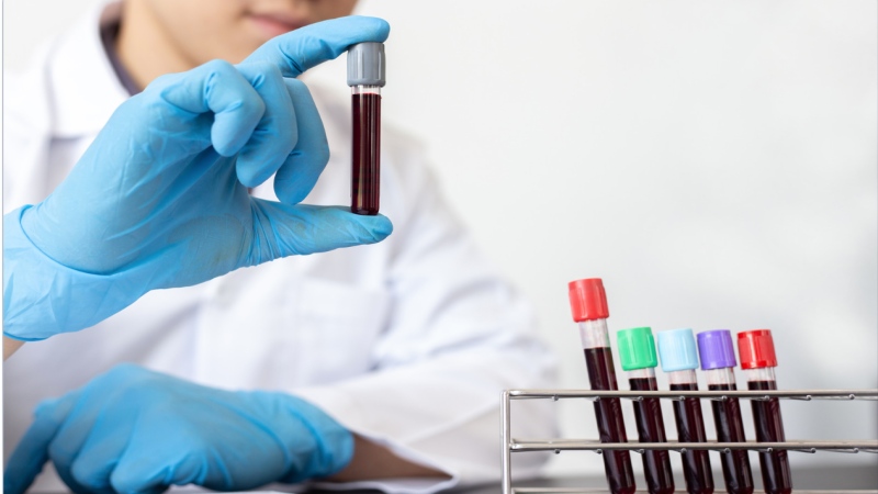 Các xét nghiệm chẩn đoán suy giảm miễn dịch bẩm sinh (Ảnh: Sưu tầm Internet)