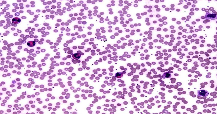 Tăng bạch cầu ái toan là gì? Nguyên nhân, dấu hiệu và cách nhận biết