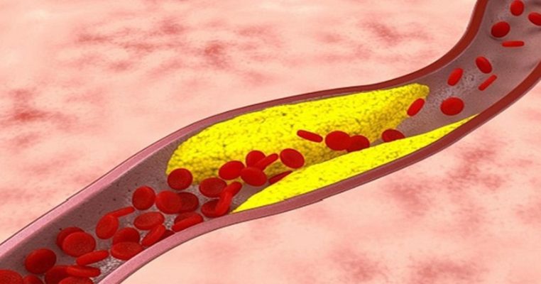 Xơ vữa động mạch là gì? Nguyên nhân thật sự nhiều người bỏ qua